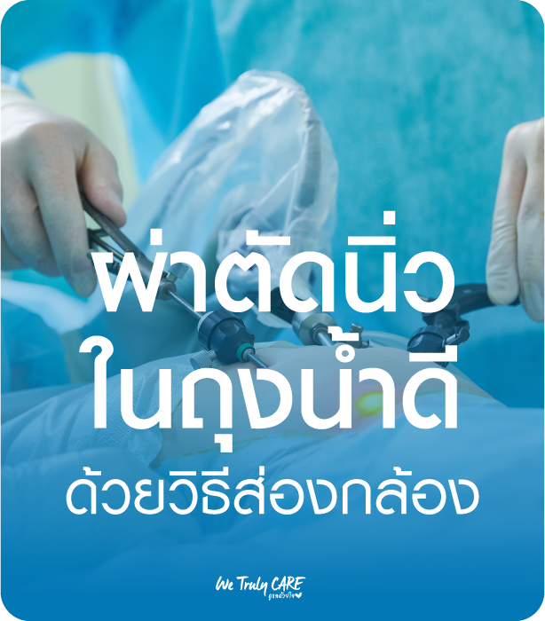 ผ่าตัดนิ่วในถุงน้ำดีด้วยวิธีส่องกล้อง