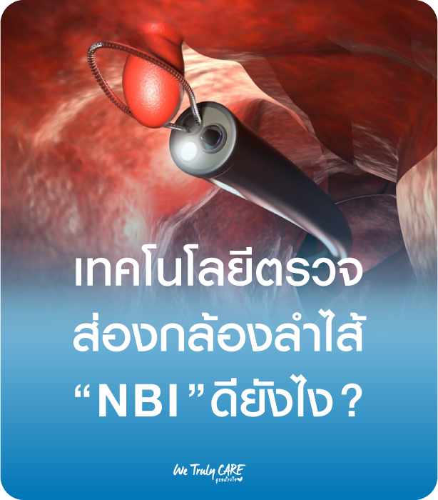 เทคโนโลยีตรวจส่องกล้องลำไส้ NBI ดียังไง